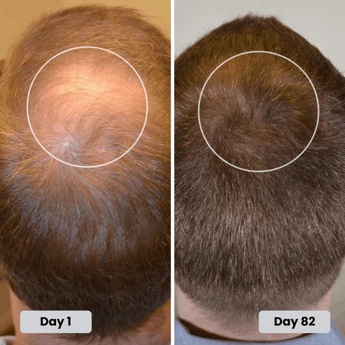 Ravlumi Pro Hair Growth Cap — 180-LED Triple Wavelength Therapy